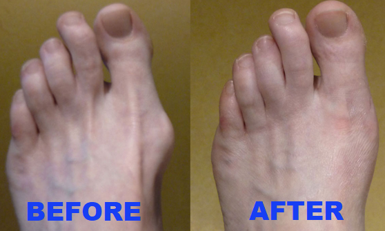 Image result for bunion correction